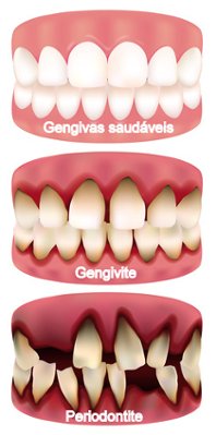 periodontite gengivite