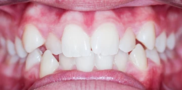 antes do tratamento ortodontico