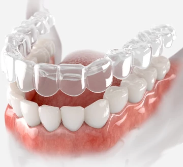 Aparelho Invisível (Invisalign) - VitaCentro