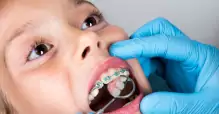 alinhamento dentes, aparelhos dentário