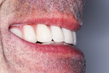após tratamento estético dentário