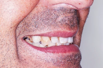 antes tratamento estético dentário