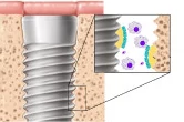osseointegração