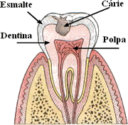 carie dentária