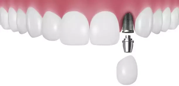 Componentes dos Implantes Dentários