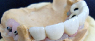 coroa dentaria