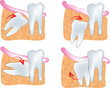 dente siso incluso