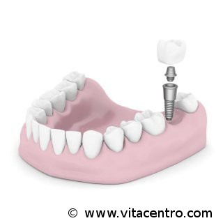 implantes dentarios