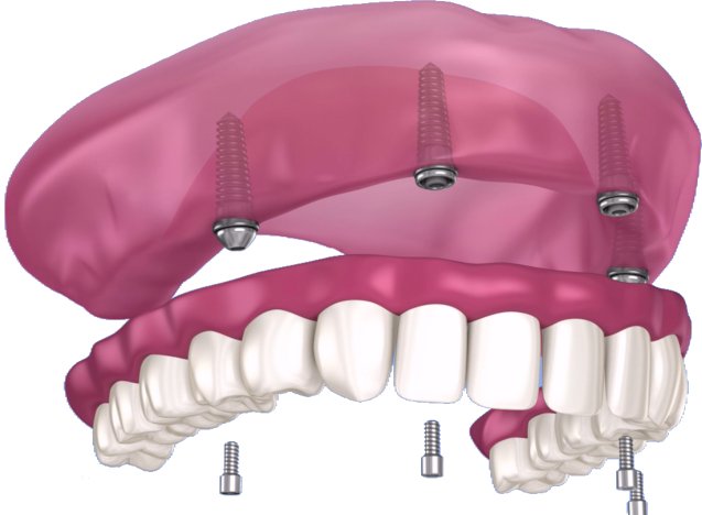 4 implantes todos os dentes