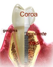 fixação implantes dentários