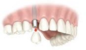 implante um dente
