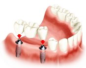 implante três dentes