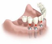 implante todos os dentes