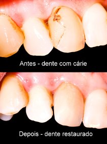 tratamento carie dentária