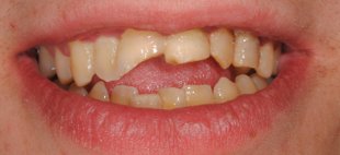 dentes centrais fraturados