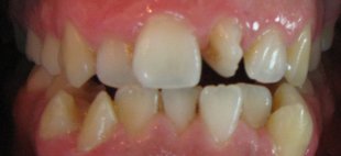 dentes desalinhados