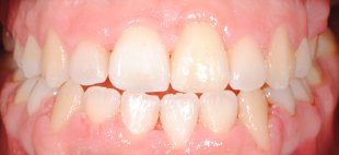 reabilização com ortodontia fixa