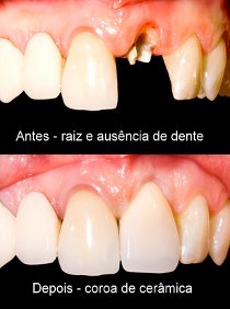 tratamento raiz dente