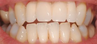 reabilização dentes centrais