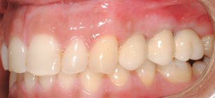 recuperação e tratamento dentes laterais