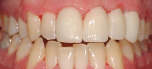 tratamento dentes centrais fraturados