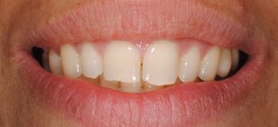 tratamento dentes laterais