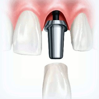 vantagens implantes dentários